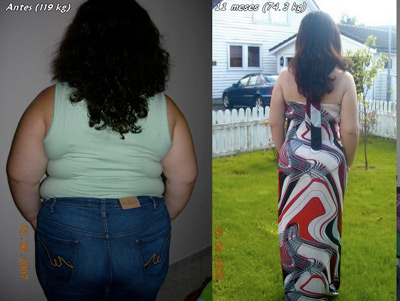 Image of a Female Patient before and after weight loss